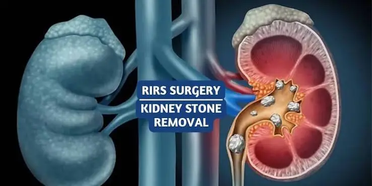 RIRS Surgery Benefits