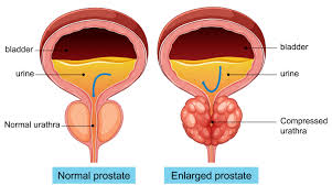 Bladder & Prostate Care